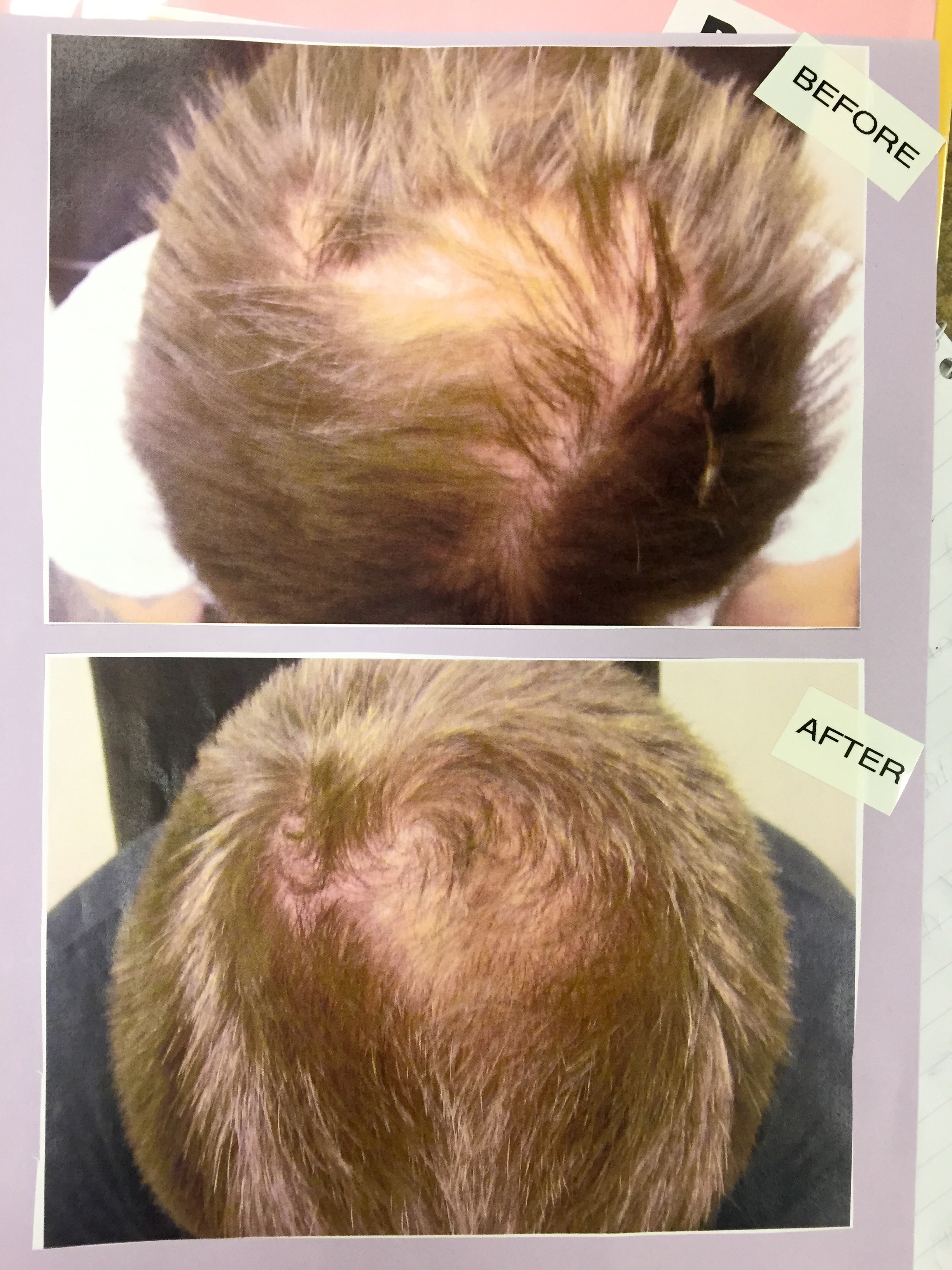 laser therapy for hair loss pictures, photos