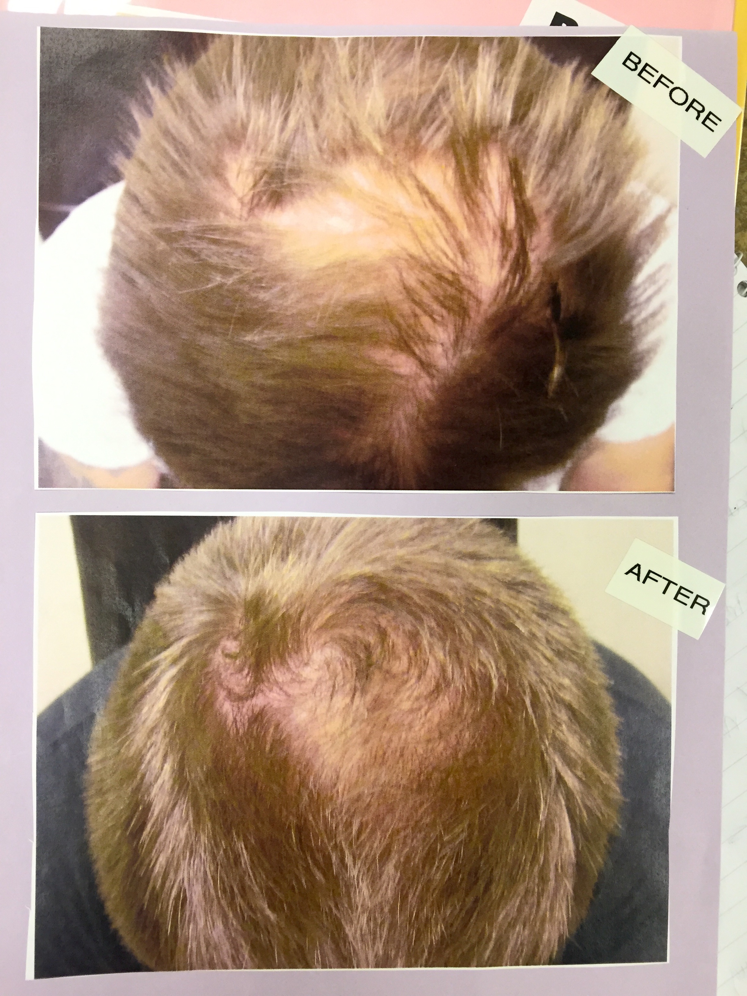 Laser Therapy For Hair Loss Pictures Photos