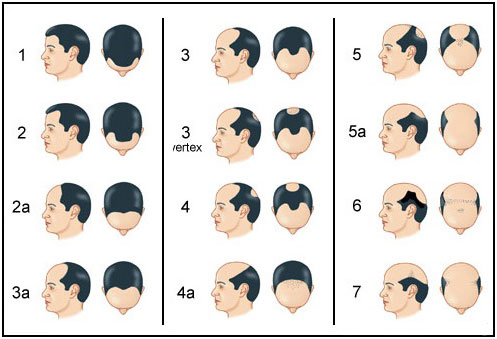 The Norwood Hair Loss Scale