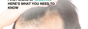 First Signs Of Balding? Here’s What You Need To Know