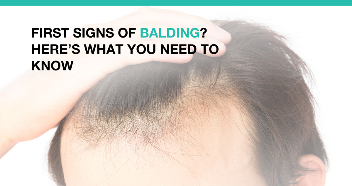 First Signs Of Balding? Here’s What You Need To Know