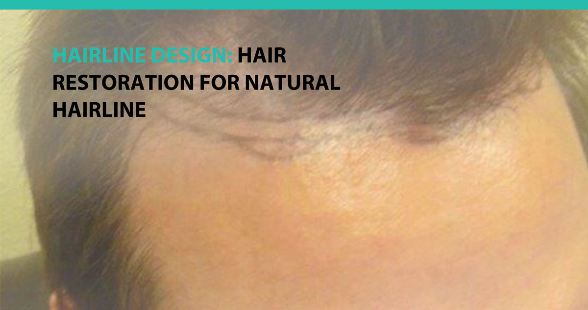 Hairline Design: Hair Restoration for Natural Hairline - Advanced Medical  Hair Institute Advanced Medical Hair Institute
