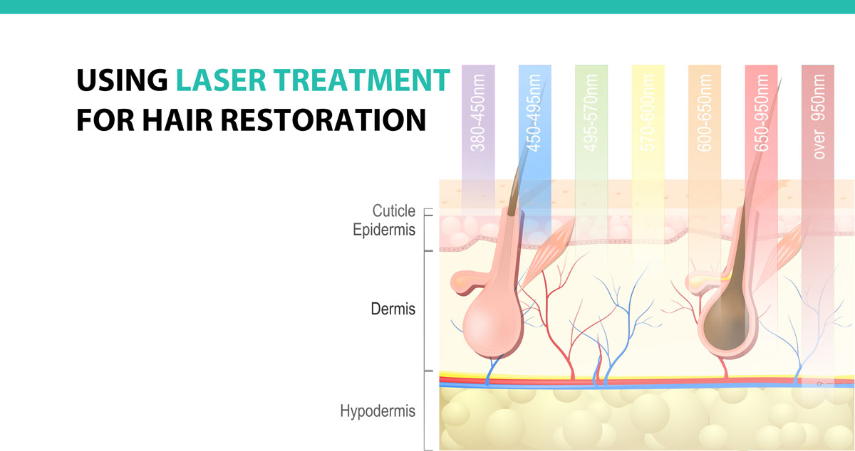 Using Laser Treatment for Hair Restoration