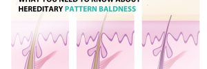 What You Need to Know About Hereditary Pattern Baldness