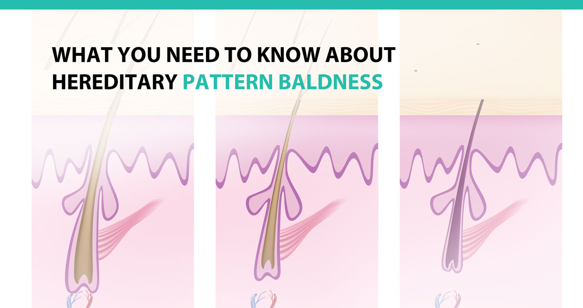 What You Need to Know About Hereditary Pattern Baldness