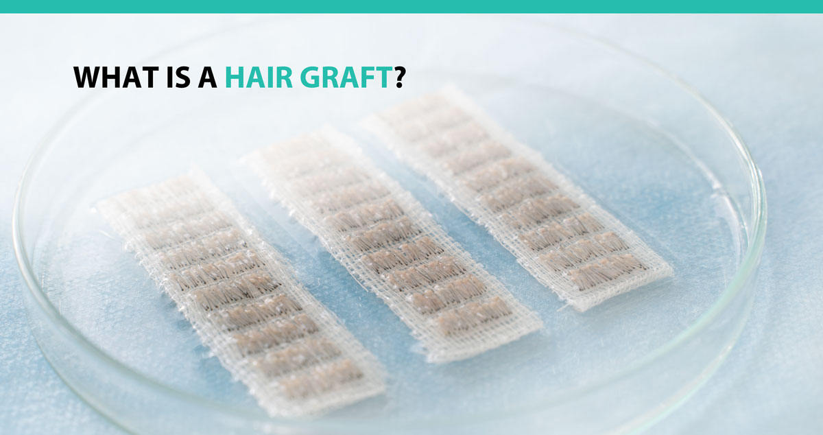 What is A Hair Graft?