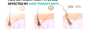 How Different Hair Types Are Affected by Hair Transplants