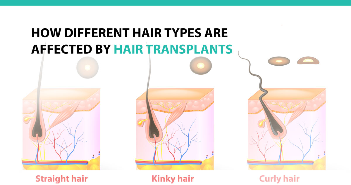 How Different Hair Types Are Affected by Hair Transplants