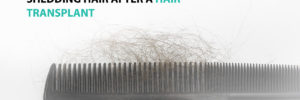 Shedding Hair after a Hair Transplant