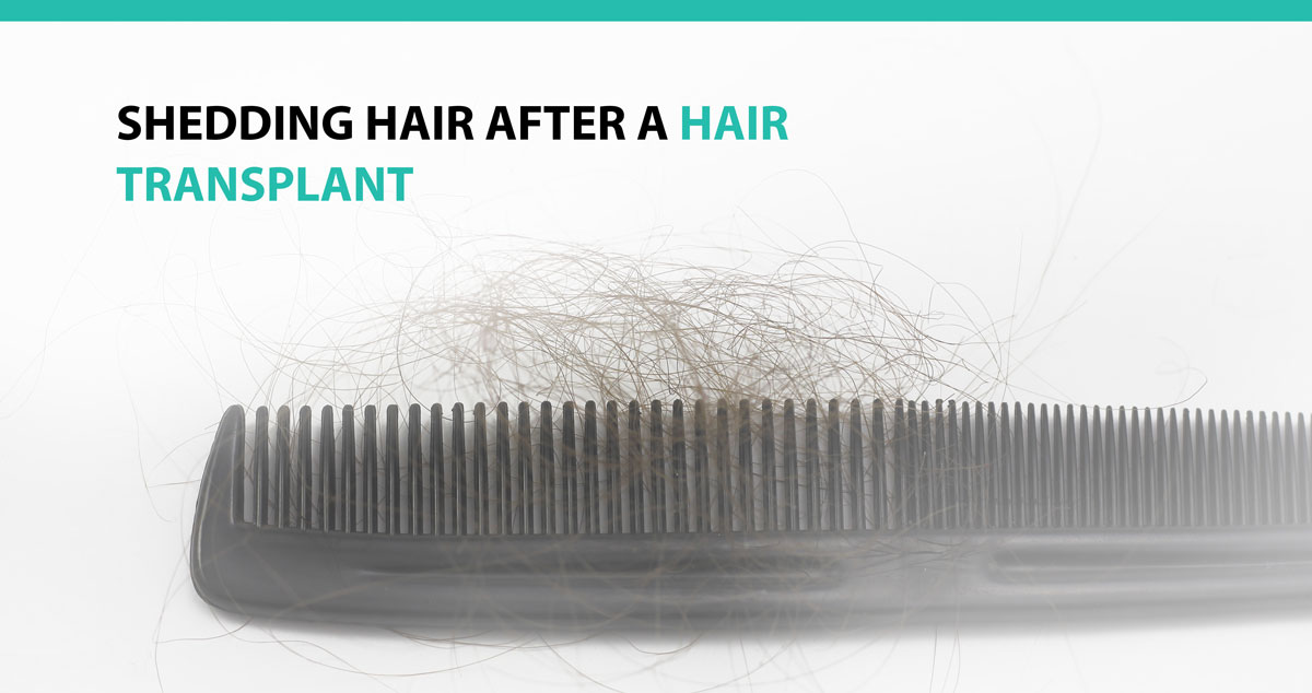 Shedding Hair after a Hair Transplant