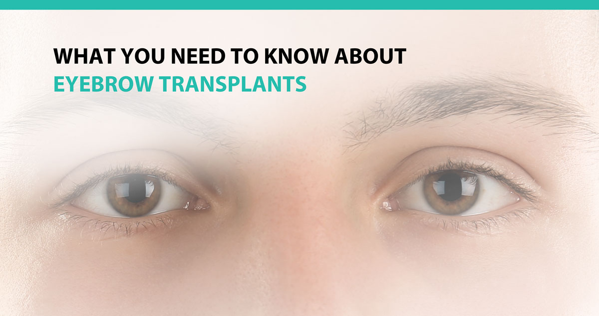 What You Need to Know About Eyebrow Transplants