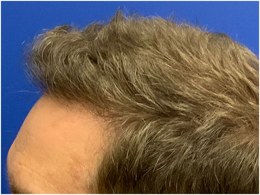 Hair Transplant - 3100 Grafts - After Photo