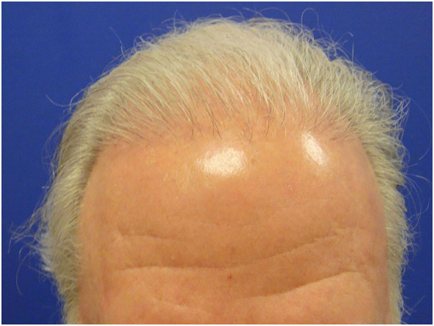 Hair Transplant - 2100 Grafts - Before Photo