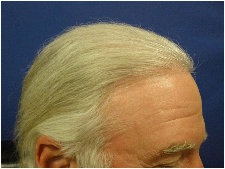 Hair Transplant - 2100 Grafts - After Photo