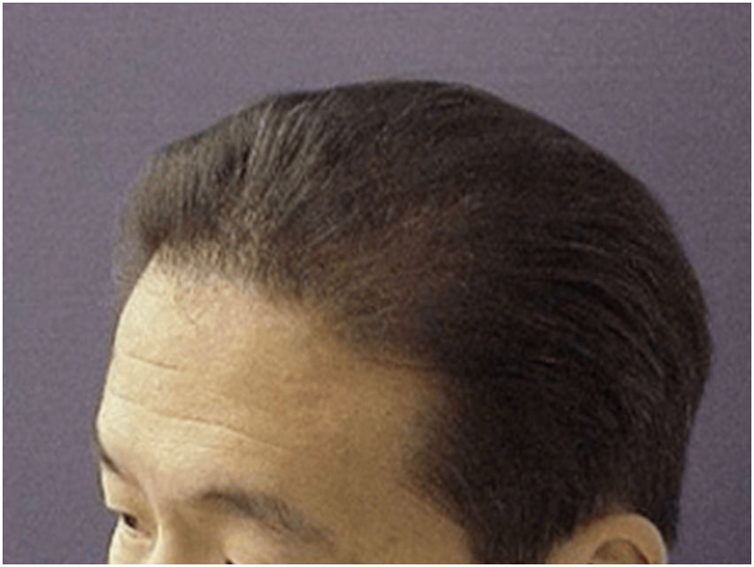 Hair Transplant - 2000 Grafts - After Photo