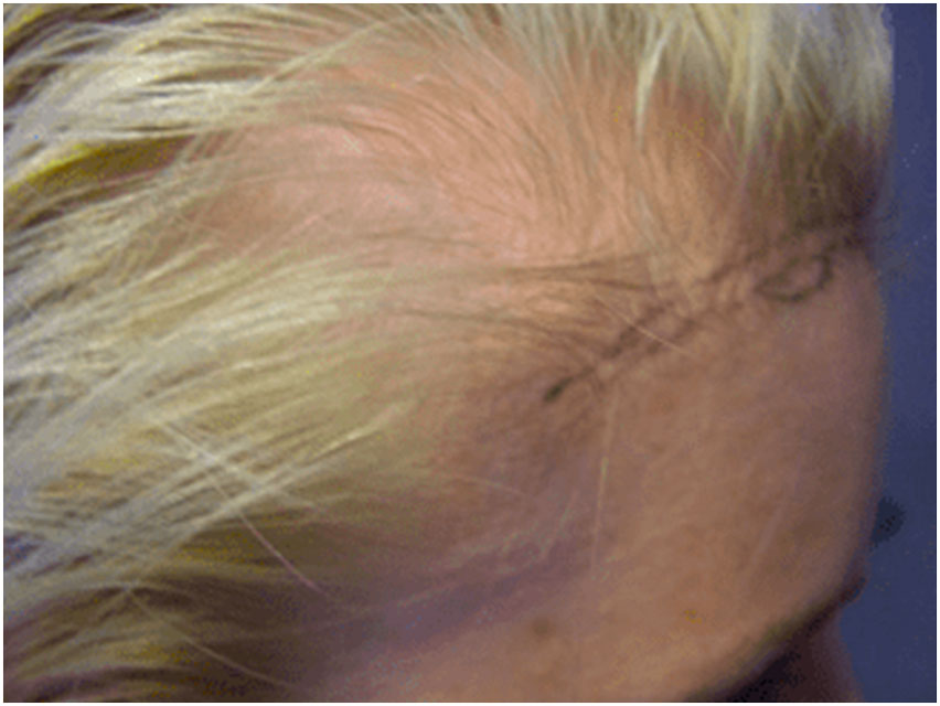 Hair Transplant - 2300 Grafts - Before Photo