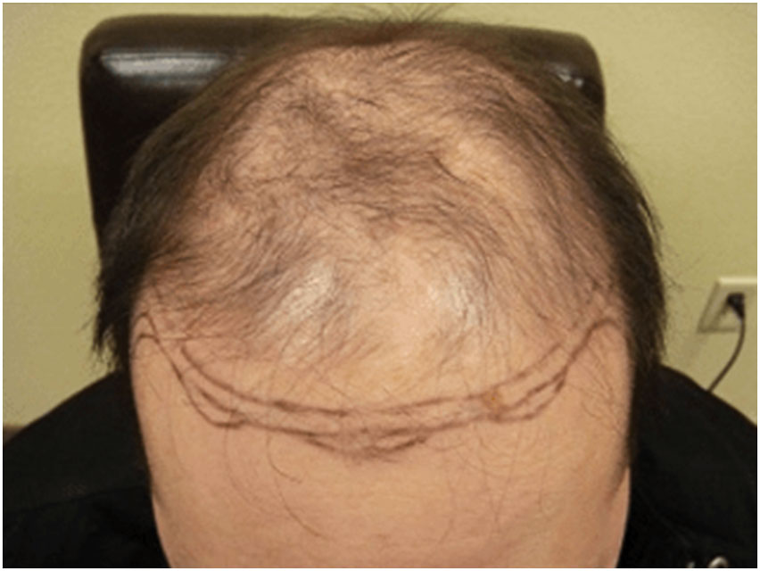 Hair Transplant - 2500 Grafts - Before Photo