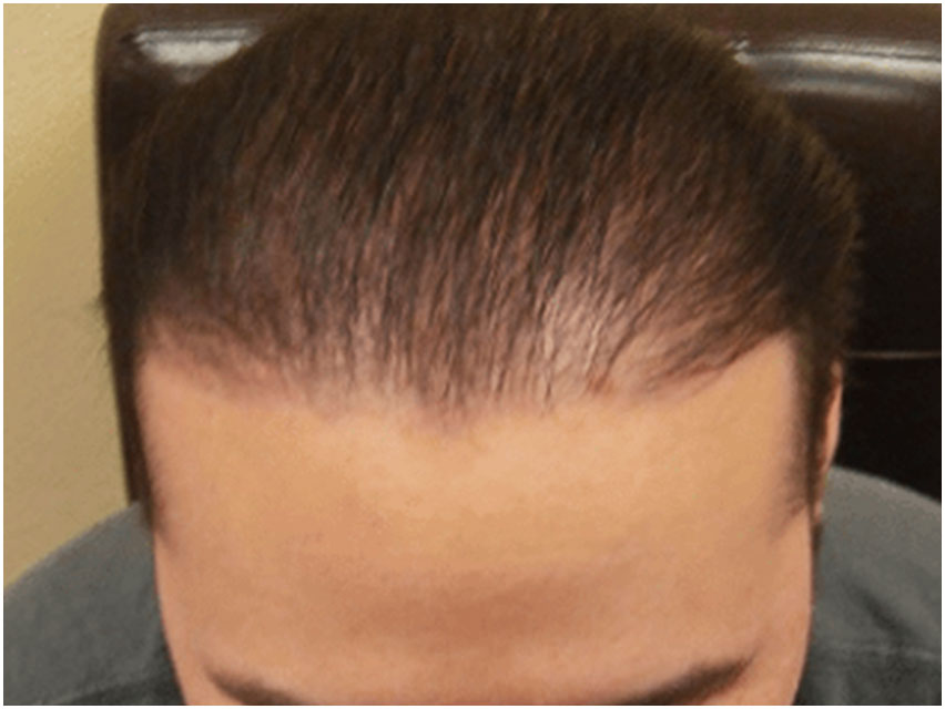 Hair Transplant - 2500 Grafts - After Photo