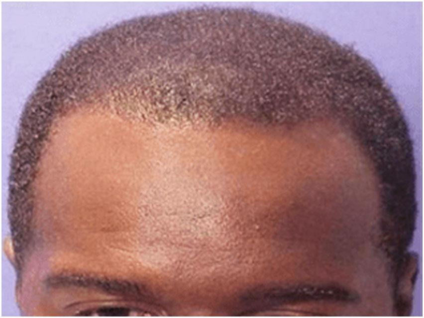 Hair Transplant - 900 Grafts - After Photo