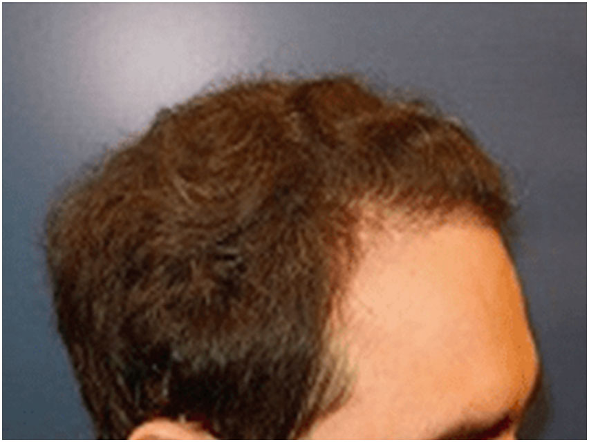 Hair Transplant - 3000 Grafts - After Photo