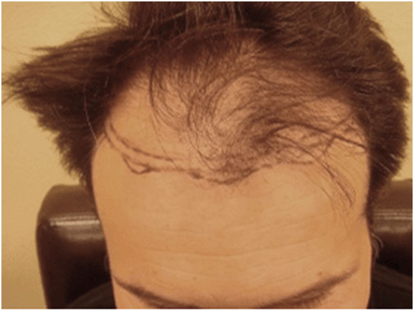 Hair Transplant - 2000 Grafts - Before Photo
