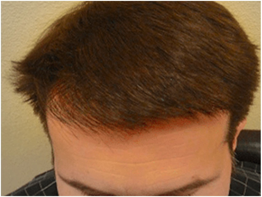 Hair Transplant - 2000 Grafts - After Photo