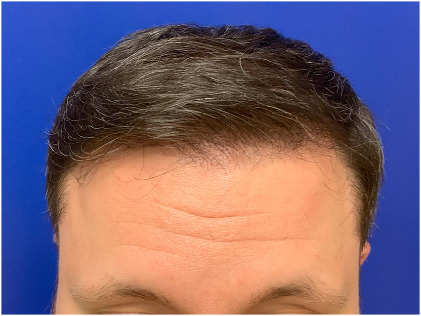 Hair Transplant - 2800 Grafts - After Photo