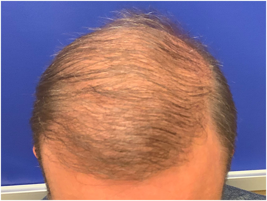 Hair Transplant - 3800 Grafts - After Photo