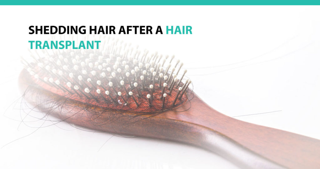 Shedding Hair after Hair Transplant - Advanced Medical Hair Institute ...