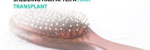 Shedding Hair after a Hair Transplant