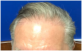 FUT Procedure - 3200 grafts - Eight Months Post-Op 1