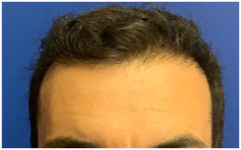 FUT Procedure - 2100 grafts - One Year Post-Op 1