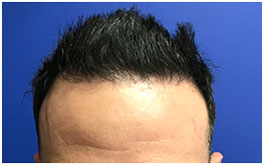 FUT Procedure - 3400 grafts - Fourteen Months Post-Op 1