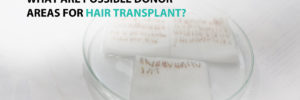 What Are Possible Donor Areas for Hair Transplant?