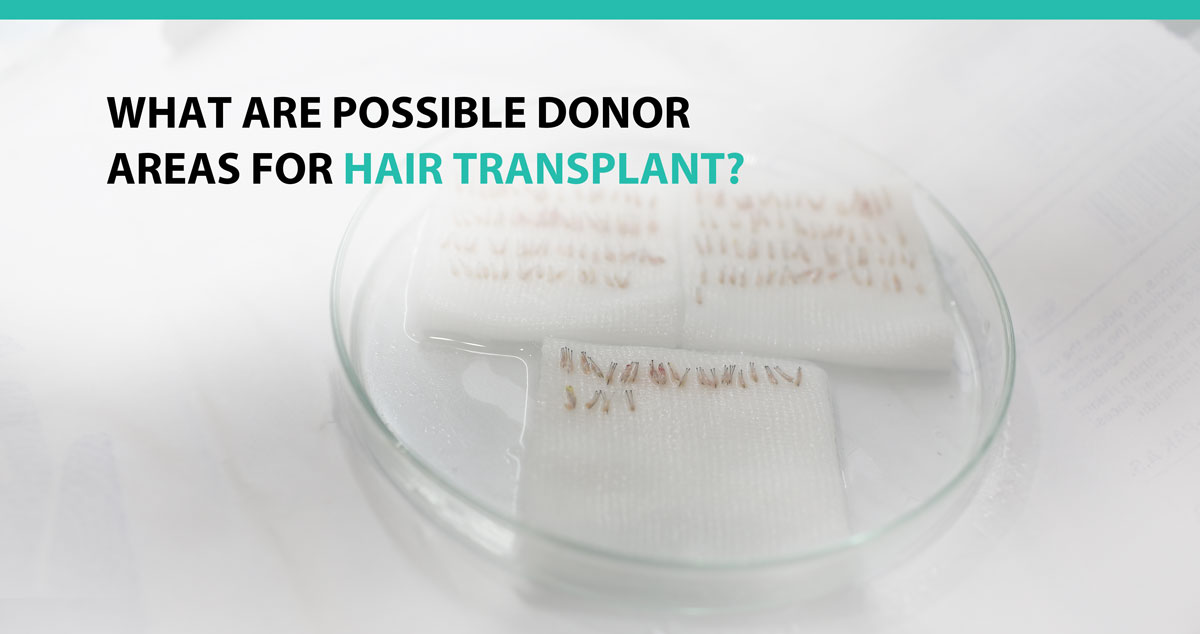 What Are Possible Donor Areas for Hair Transplant?