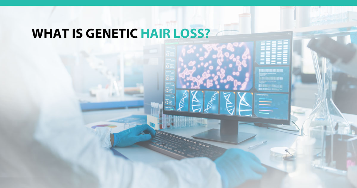 What Is Genetic Hair Loss?