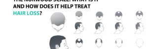 The Norwood Scale: What Is It and How Does It Help Treat Hair Loss?