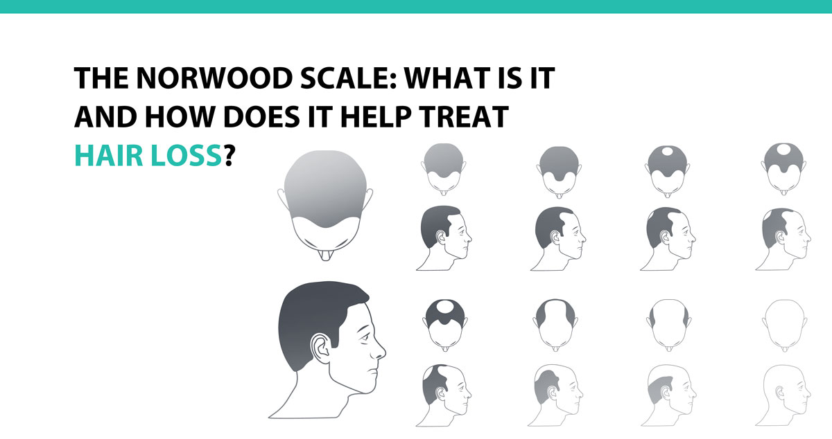 The Norwood Scale: What Is It and How Does It Help Treat Hair Loss?