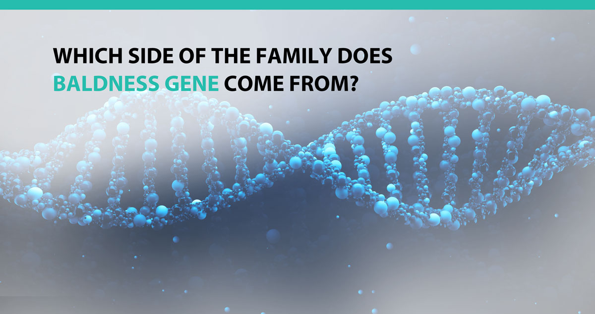 Which Side of the Family Does the Baldness Gene Come From? - Advanced  Medical Hair Institute Advanced Medical Hair Institute