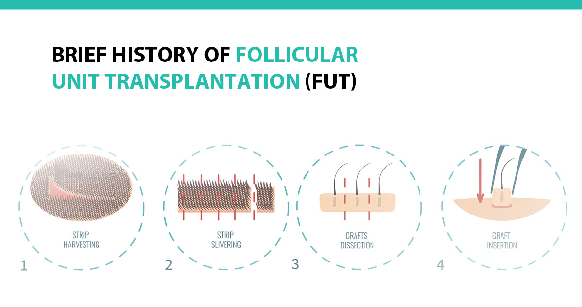 Brief History of Follicular Unit Transplantation (FUT)