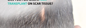 Can you Perform a Hair Transplant on Scar Tissue?