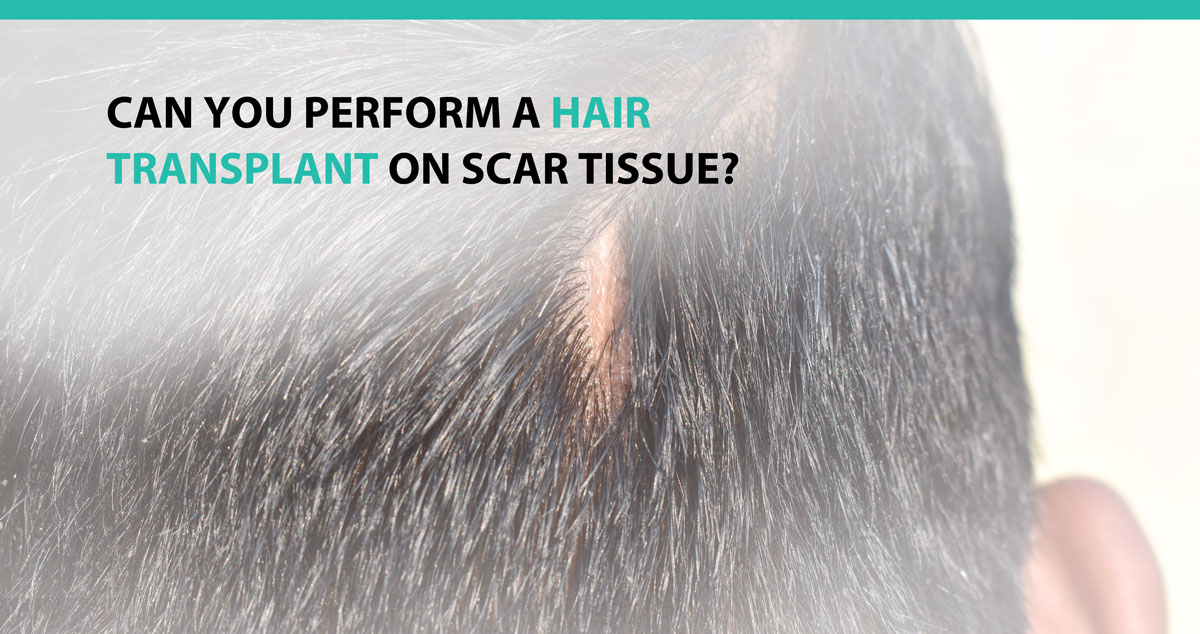 Can you Perform a Hair Transplant on Scar Tissue?