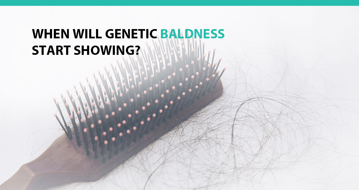 When Will Genetic Baldness Start Showing?