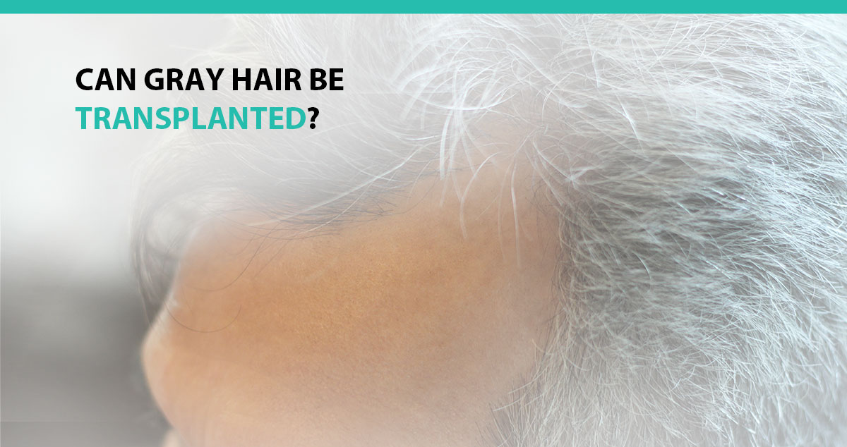 Can Gray Hair Be Transplanted?