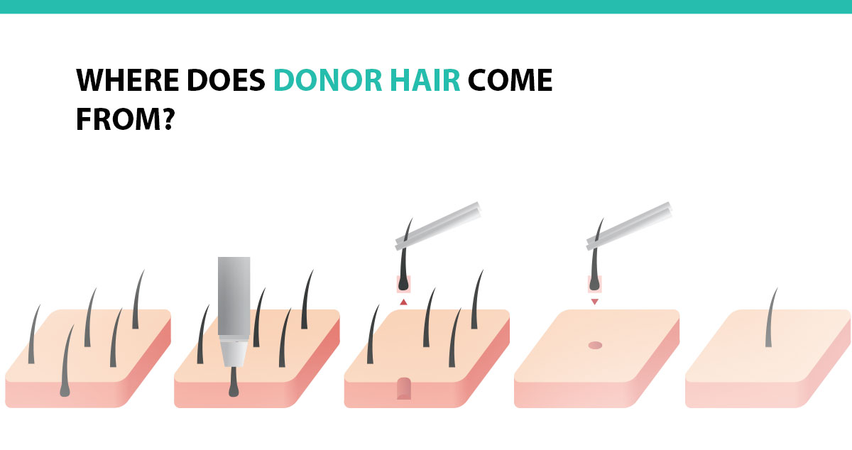 Where Does Donor Hair Come From?