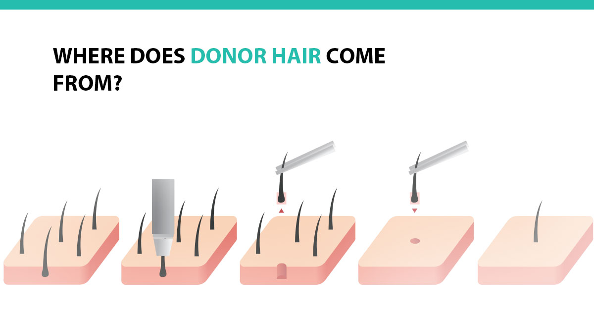 Where Does Donor Hair Come From? - Advanced Medical Hair Institute ...