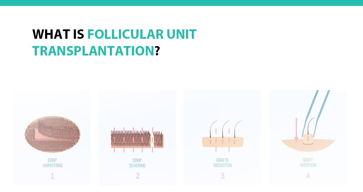 What Is Follicular Unit Transplantation?