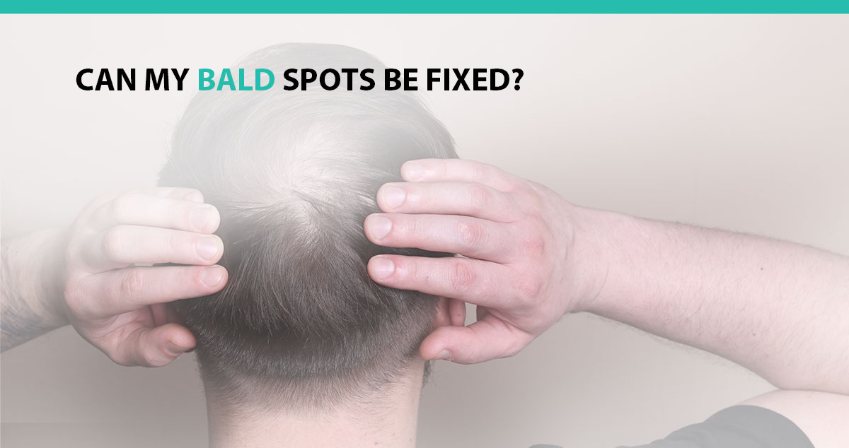 Can My Bald Spots Be Fixed?