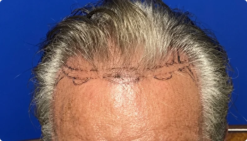 Hair transplant recovery stitches